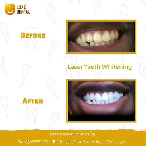 Teeth Whitening in Lagos