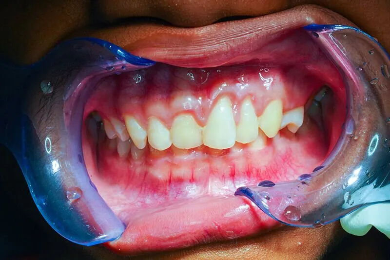 Gum Disease Treatment in Lagos
