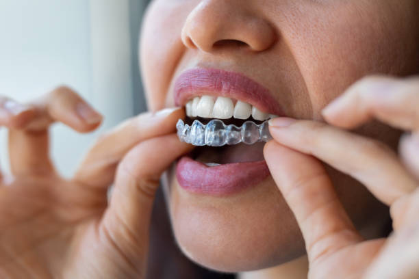 Clear Aligners in Lagos