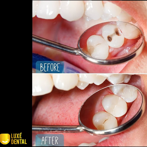 tooth filling in Lagos