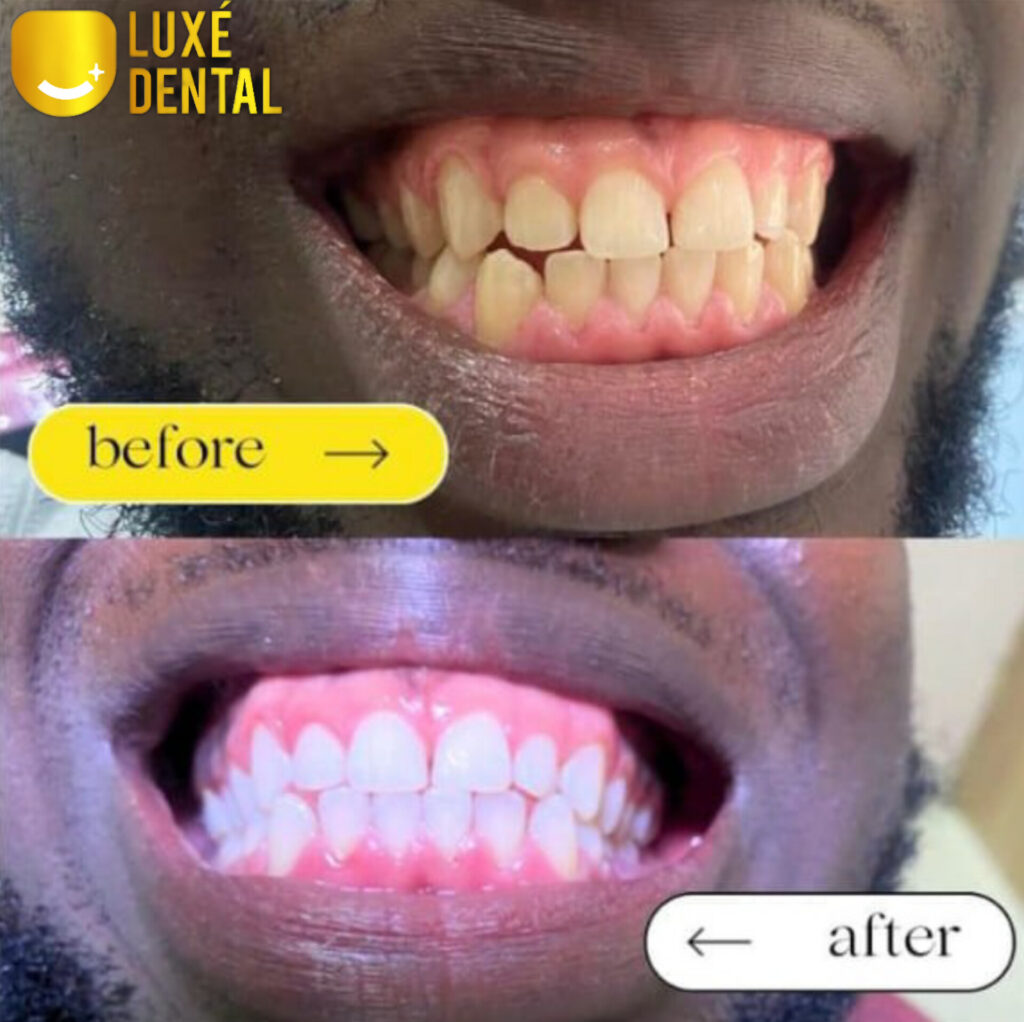 teeth whitening in Lagos