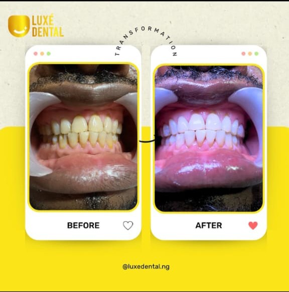 teeth whitening in Lagos