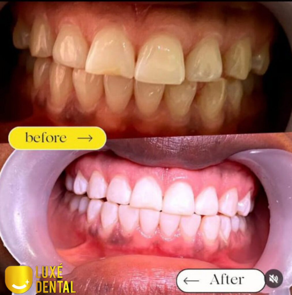 Teeth Whitening in Lagos