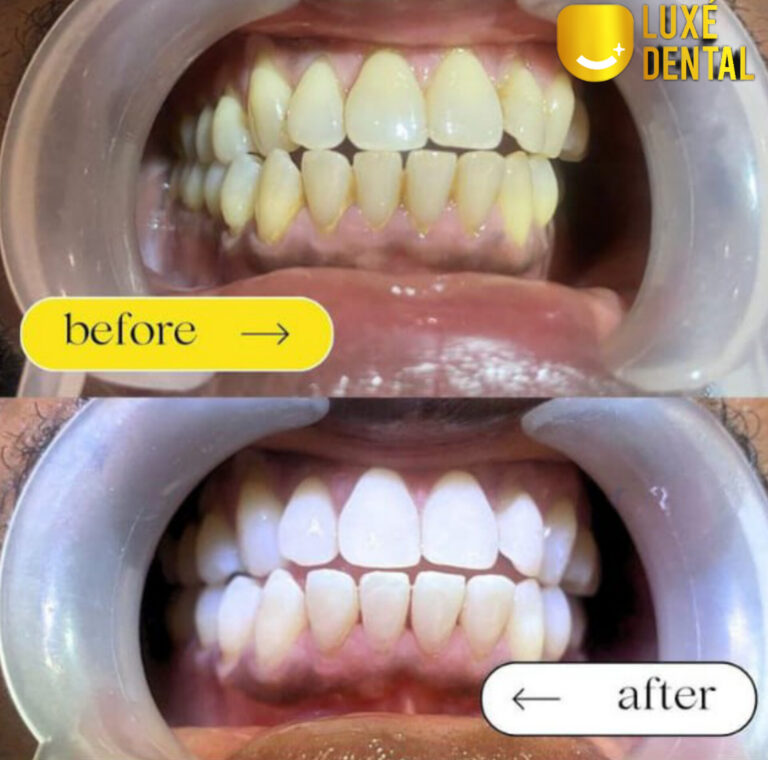 teeth whitening in Lagos