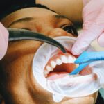 causes of bleeding gums