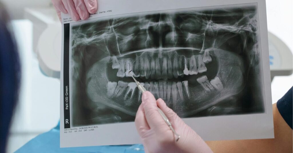 Full Mouth Reconstruction