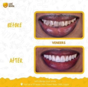 Veneers Cost in Nigeria