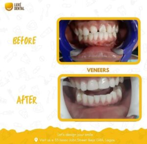 Veneers Cost in Nigeria