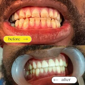 Veneers Cost in Nigeria