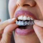 Facts About Invisalign