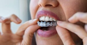 Facts About Invisalign