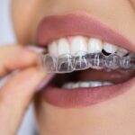 Blogpost on what can clear aligners fix