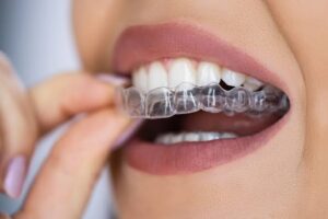 Blogpost on what can clear aligners fix