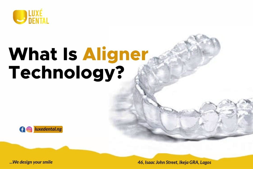 What is Aligner