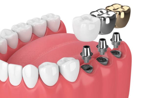 3d render of jaw with teeth and three types of implants over white